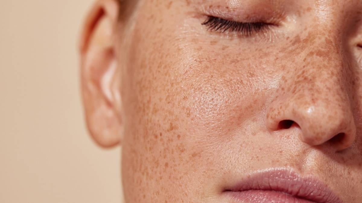 facial despigmentante en Mexicali